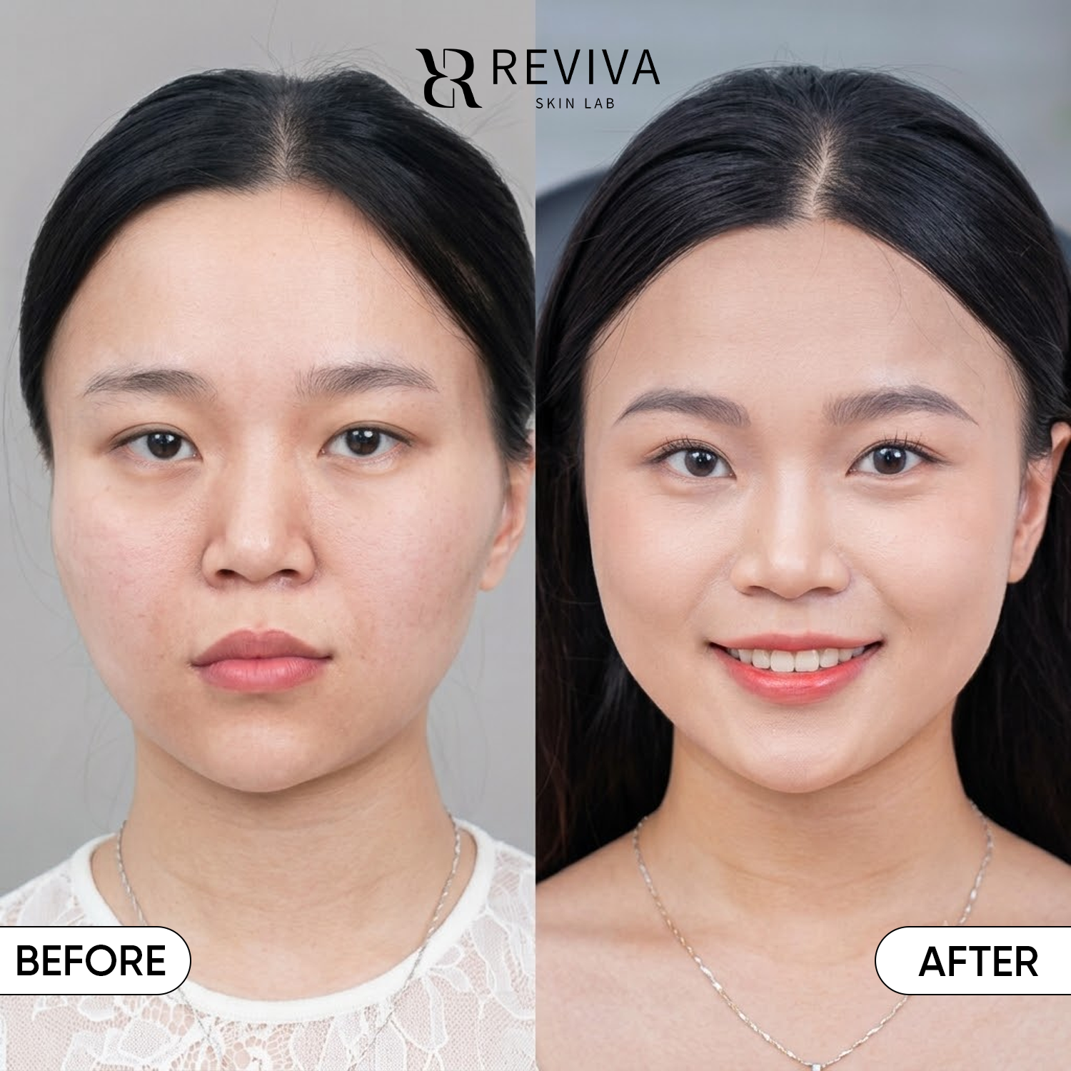 Restoring Fuller & More Balanced Contours